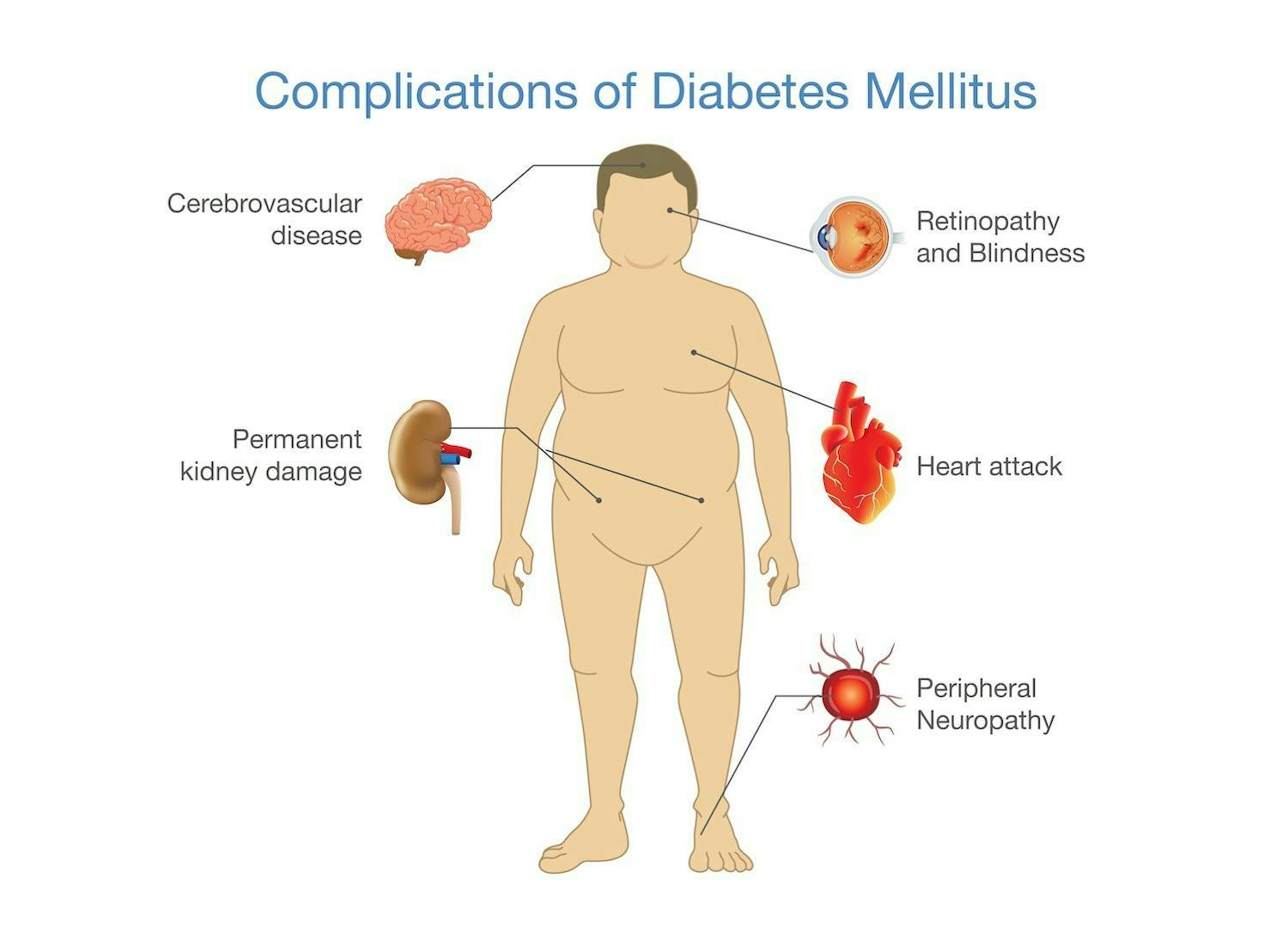 The complications of type 2 diabetes